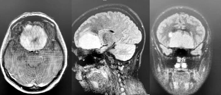 Exame de imagem mostrando um tumor comprimindo estruturas do cérebro