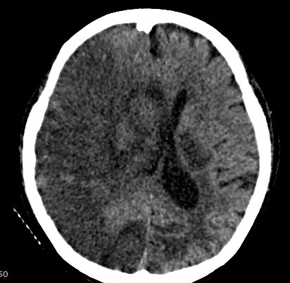 Tomografia de crânio com infarto cerebral respeitando o território vascular