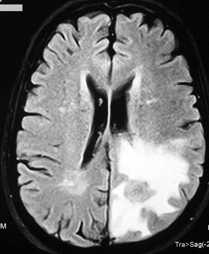 Ressonância FLAIR com edema vasogênico digitiforme ao redor de um tumor
