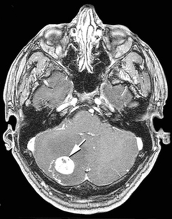 Ressonância magnética de hemangioblastoma no cerebelo, com cisto e nódulo