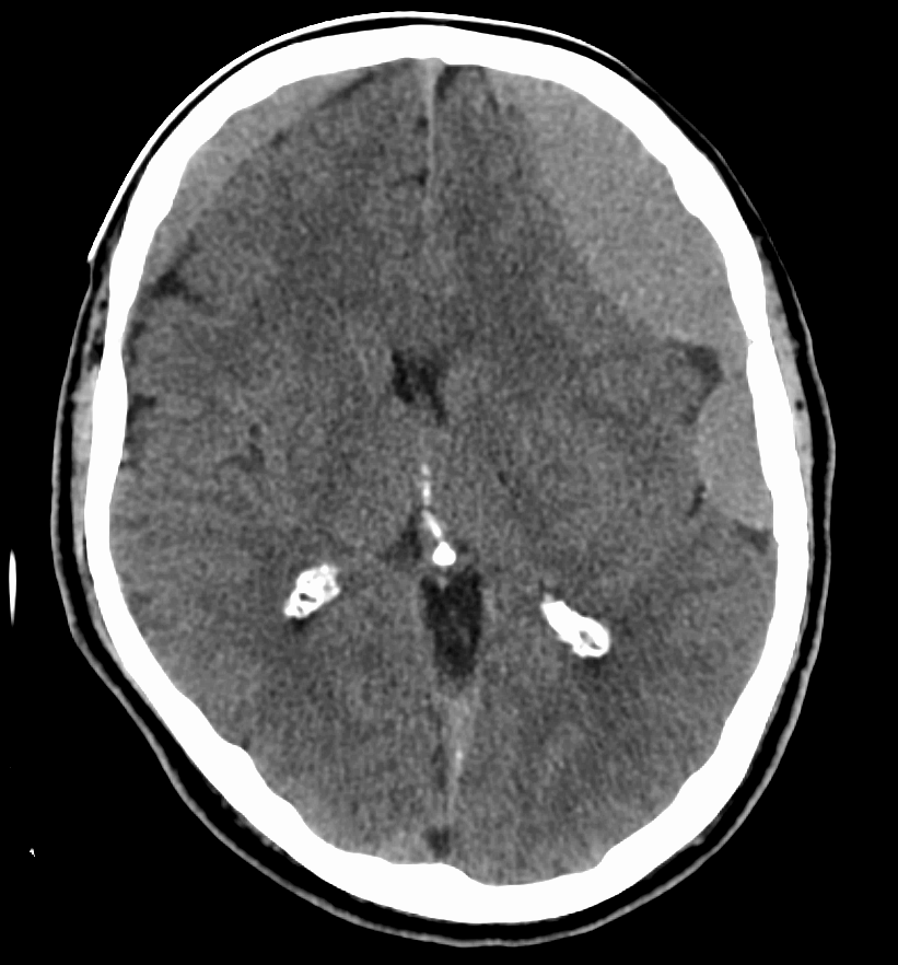 Tomografia de crânio com hematoma subdural crônico