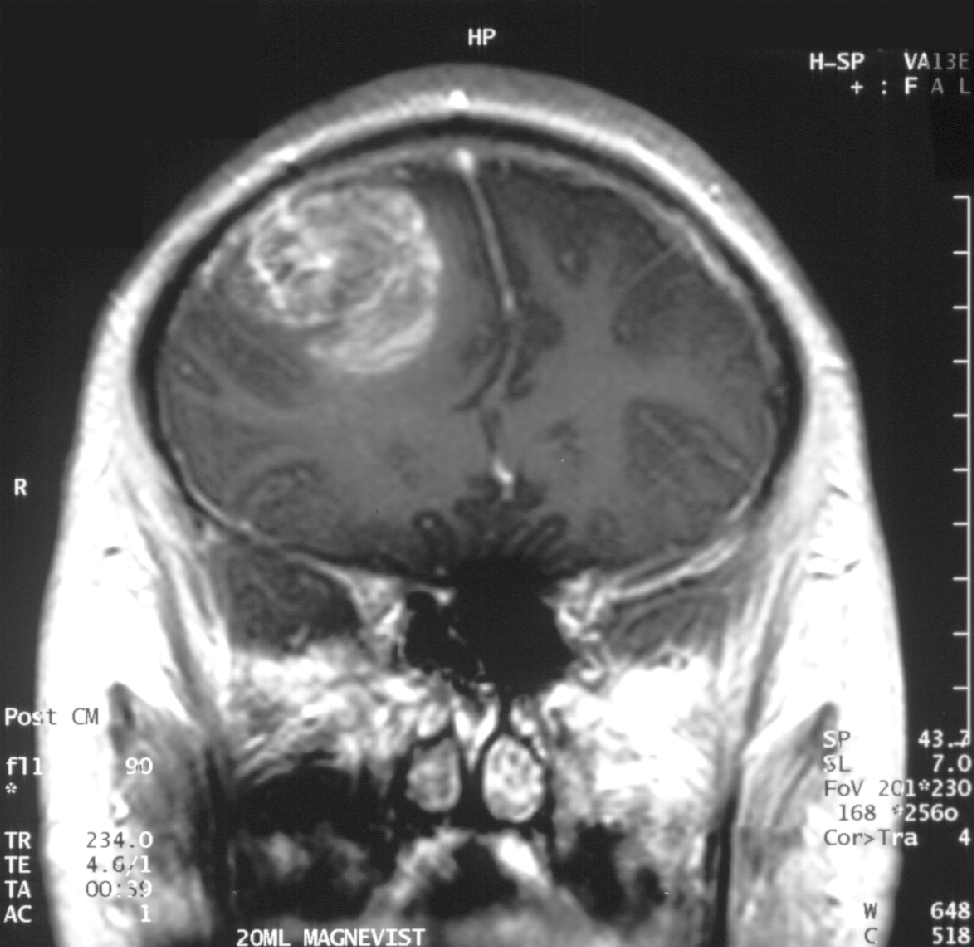 Ressonância magnética de um tumor cerebral com contraste