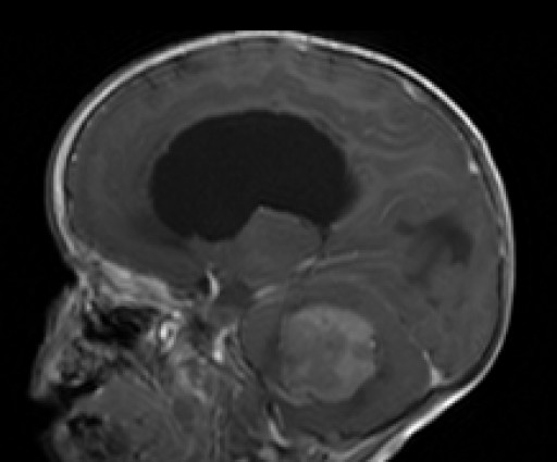 Ressonância sagital mostrando tumor na fossa posterior com hidrocefalia