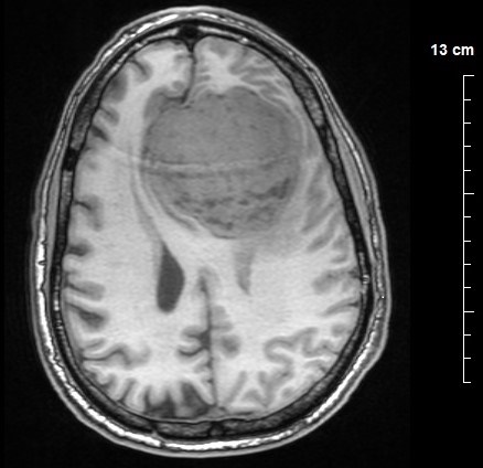 Ressonância magnética mostrando um meningioma grande