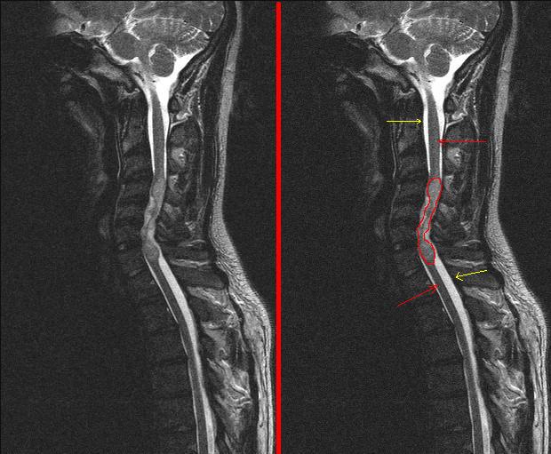 Ressonância sagital do pescoço mostrando um tumor dentro da medula cervical